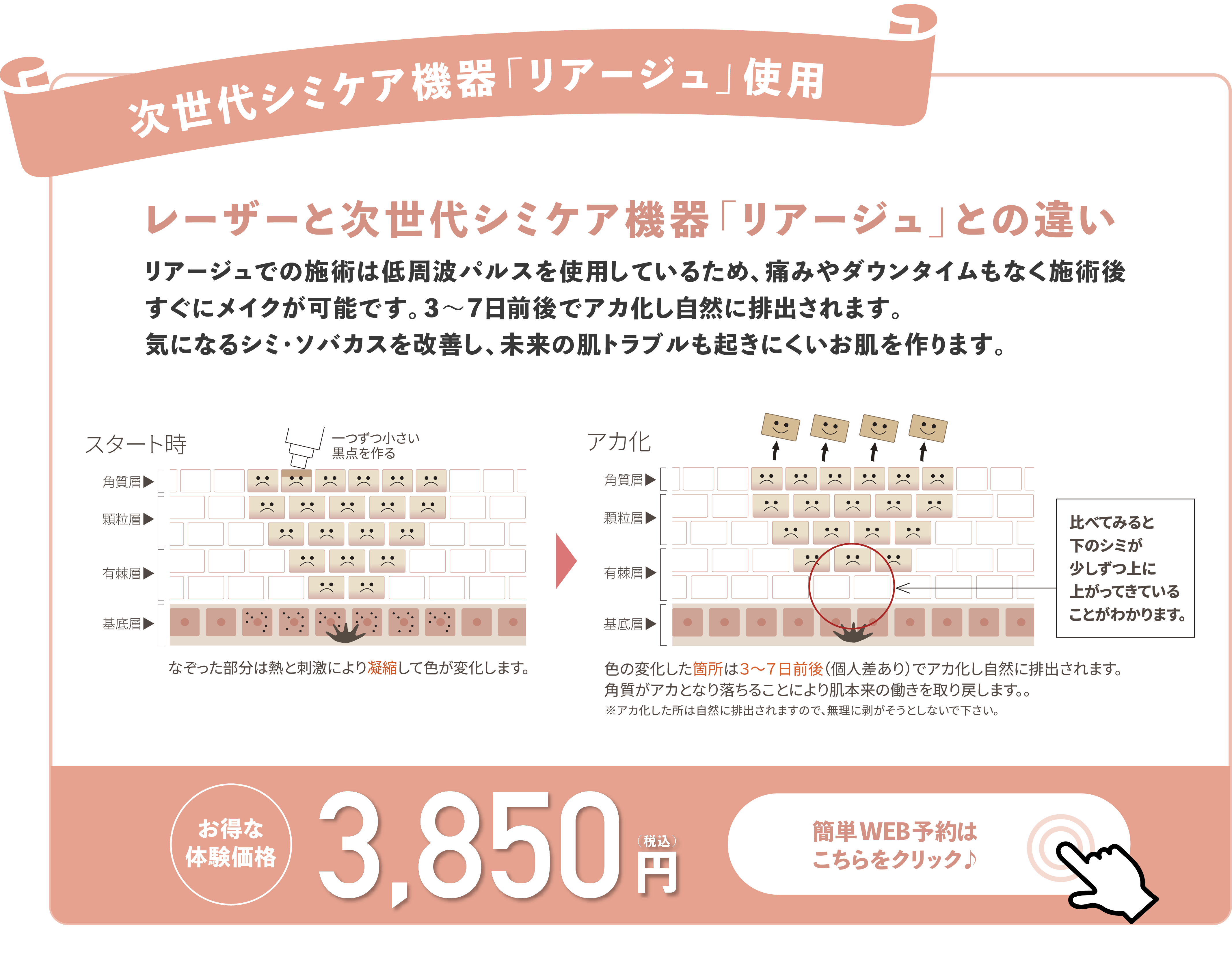 レーザーと次世代シミケア機器「リアージュ」との違い
